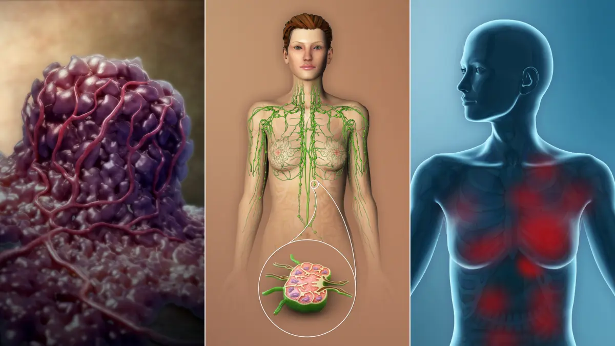 Breast Cancer Stages TNM staging system medical illustration showing tumor node metastasis progression