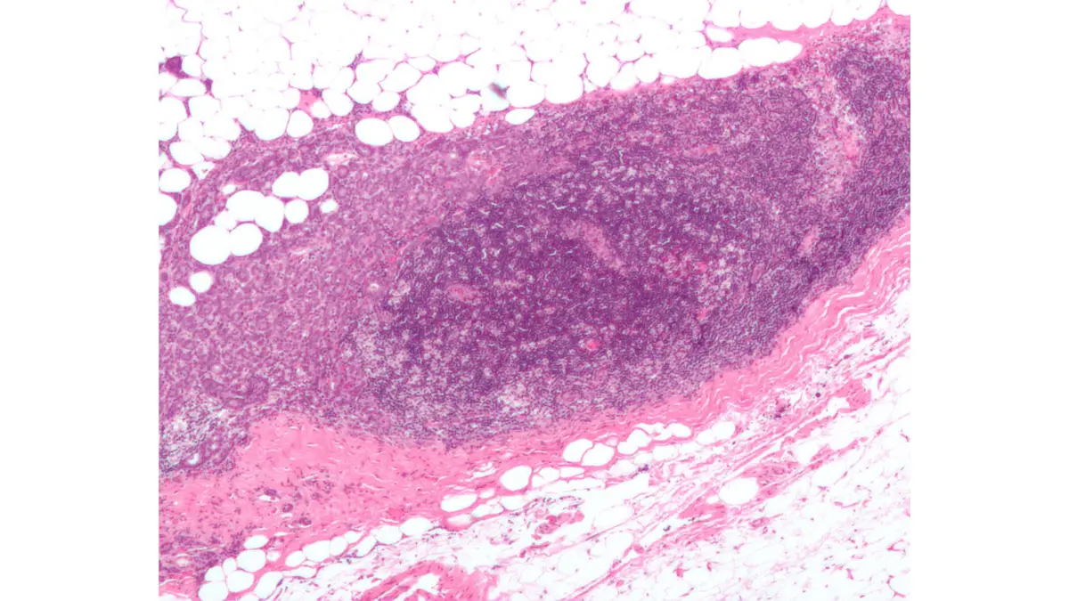 Breast Cancer Stages 3D medical illustration showing malignant breast tumor biology and progression