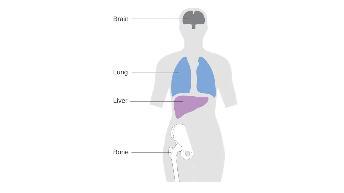 breast cancer survival rates diagram showing the most common metastatic spread sites including bone liver lungs and brain