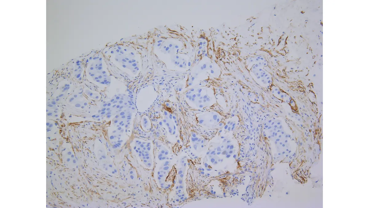 breast cancer symptoms inflammatory breast cancer histopathology illustration