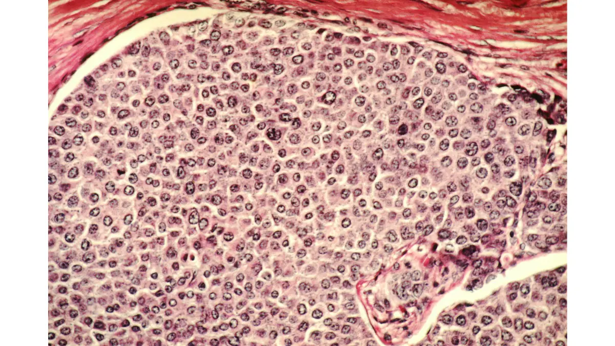 Breast Cancer Types microscopic illustration showing invasive breast cancer cells
