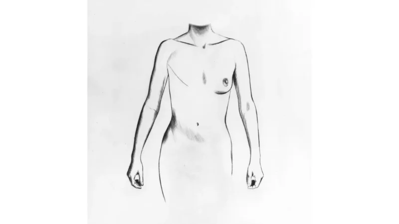 Breast Reconstruction implant illustration showing the post-mastectomy breast shape restored with an implant.