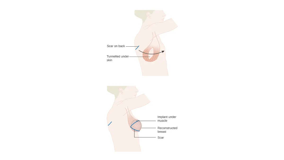 Breast Reconstruction latissimus dorsi flap illustration showing back muscle transfer with implant support.