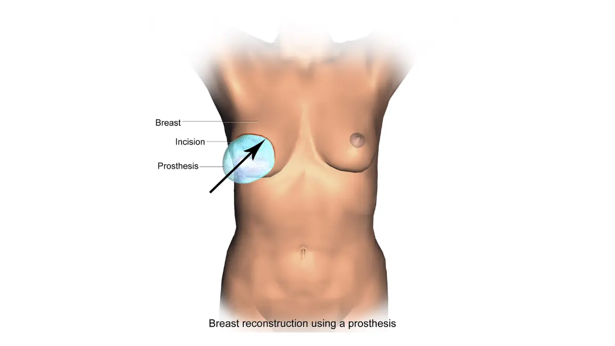 Breast Reconstruction permanent implant prosthesis illustration showing the final implant-based reconstruction result.