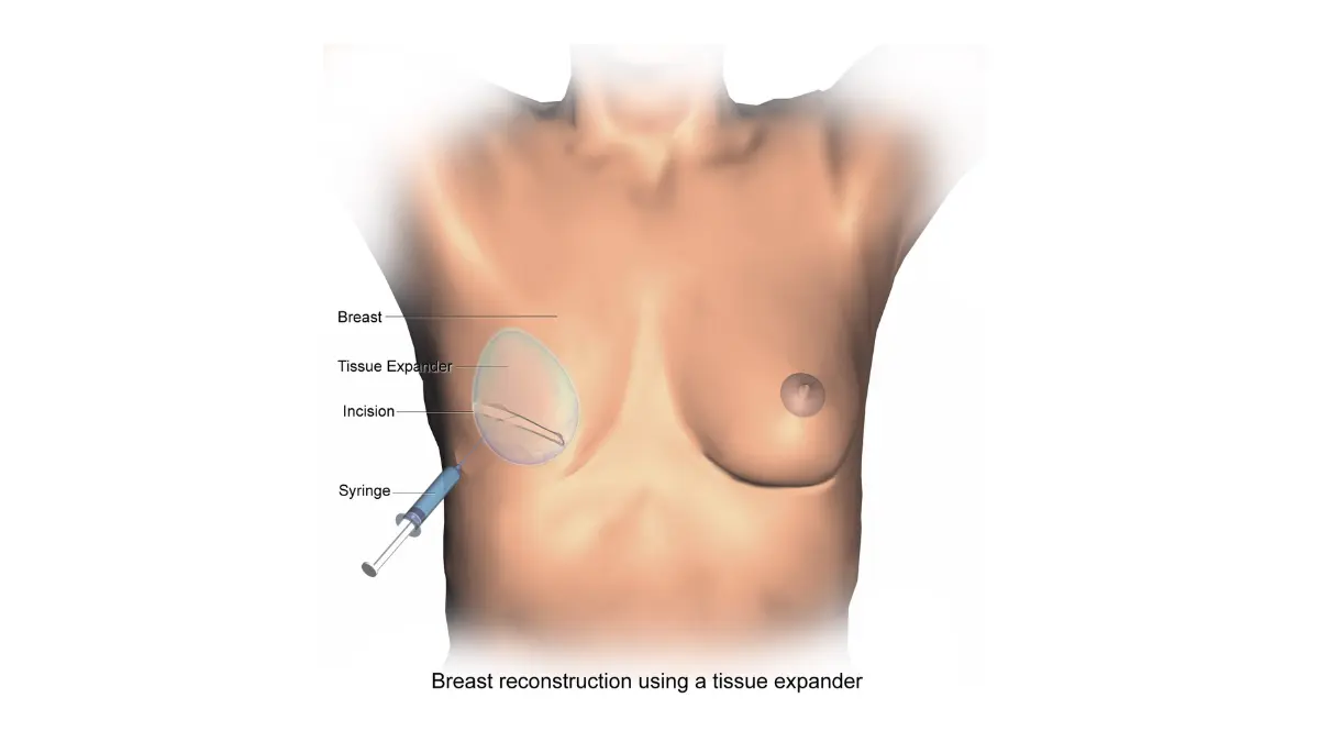 Breast Reconstruction tissue expander illustration showing temporary expander placement after mastectomy.