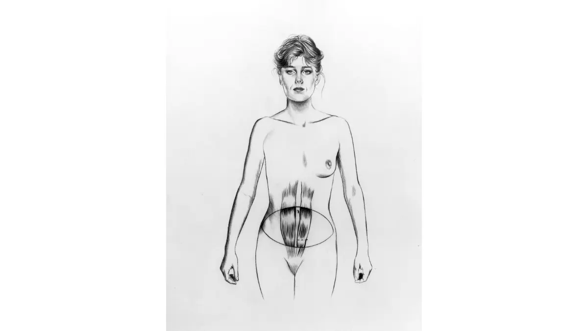 Breast Reconstruction TRAM flap illustration showing rectus abdominis tissue transfer for autologous reconstruction.