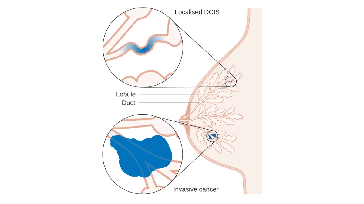 Medical diagram of DCIS breast cancer showing abnormal cells confined inside a breast duct with an intact basement membrane.