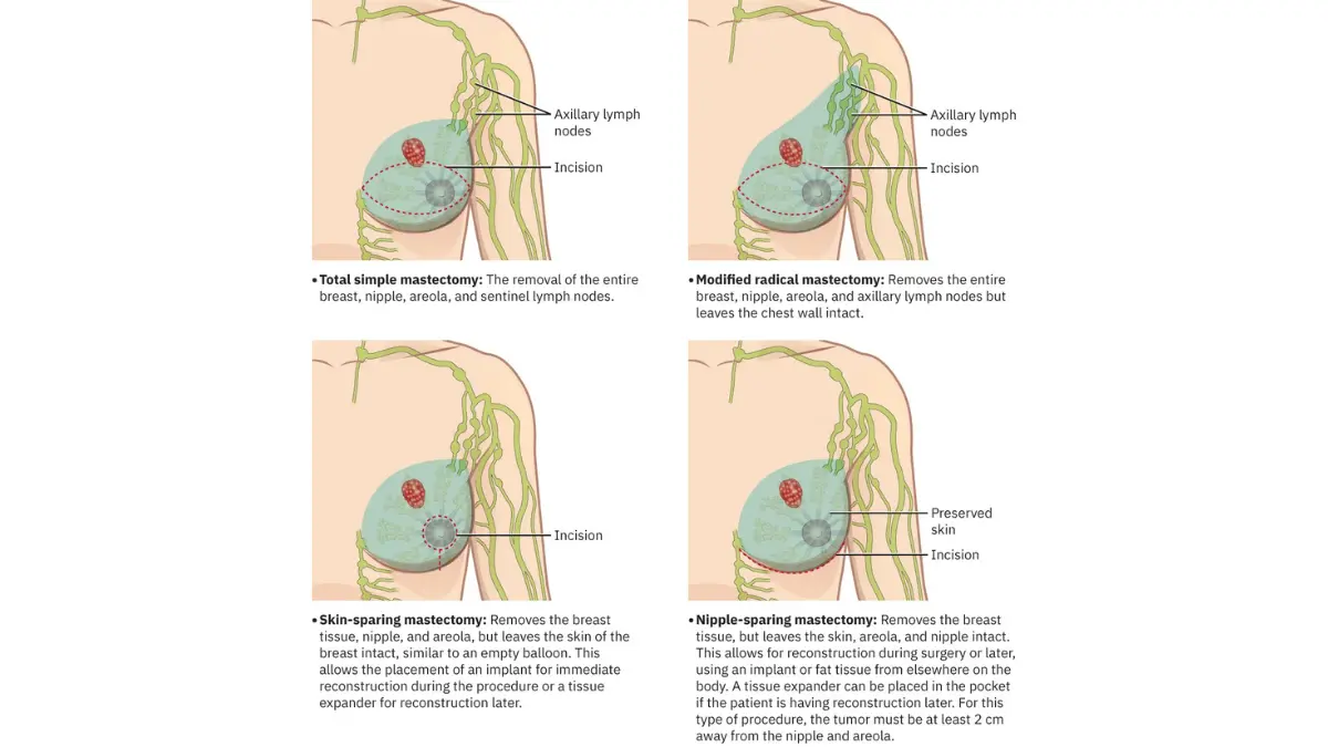 DCIS breast cancer surgery illustration comparing breast-conserving surgery and different types of mastectomy procedures.
