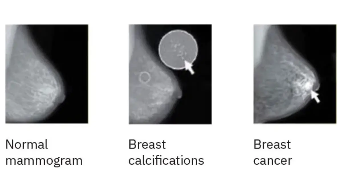 DCIS breast cancer mammogram illustration showing benign macrocalcifications and suspicious clustered microcalcifications in breast tissue.