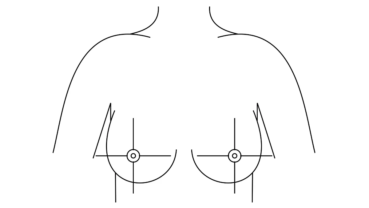 Dense breast anatomy reference vector showing breast quadrant divisions used by gynecologic oncologists during risk assessment and supplemental screening consultations.