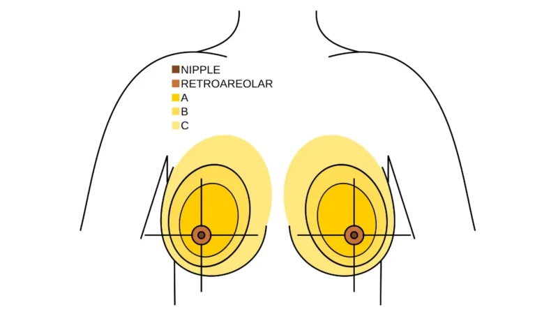 Dense breast clinical anatomy vector showing the four breast quadrants used in mammogram reporting and dense breast screening navigation.