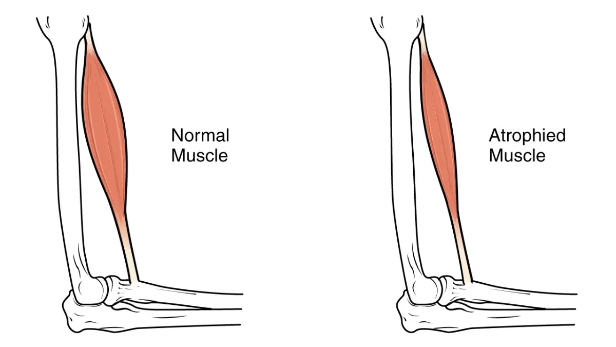Exercise and lung cancer — muscle atrophy diagram showing sarcopenia from treatment-related physical inactivity and how resistance exercise prevents muscle loss during chemotherapy and radiation