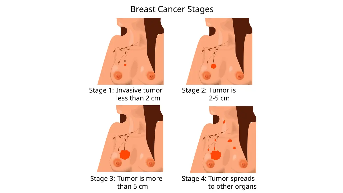 HER2-Positive breast cancer stages illustration showing tumor progression from Stage 1 to Stage 4
