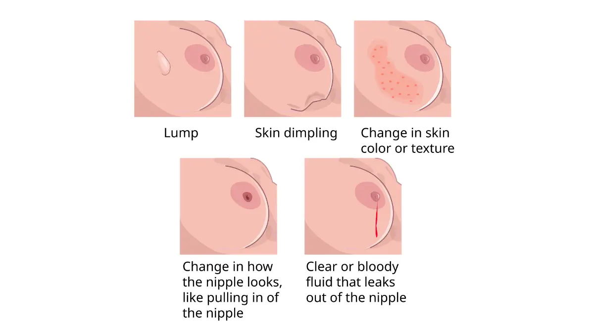 HER2-Positive breast cancer early warning signs illustration showing visible symptom changes
