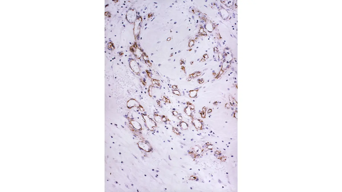 Inflammatory Breast Cancer biopsy histology image showing carcinoma cells under microscopic pathology examination