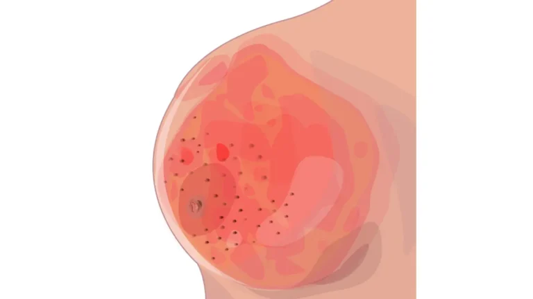 Inflammatory Breast Cancer illustration showing peau d’orange skin thickening redness and nipple changes