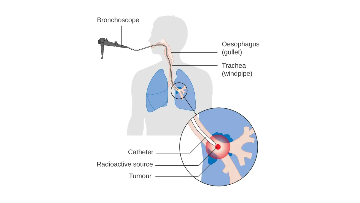 Cancer Research UK diagram showing how internal radiotherapy is delivered for lung cancer — radiation therapy for lung cancer uses image-guided beam targeting for SBRT and IMRT sessions