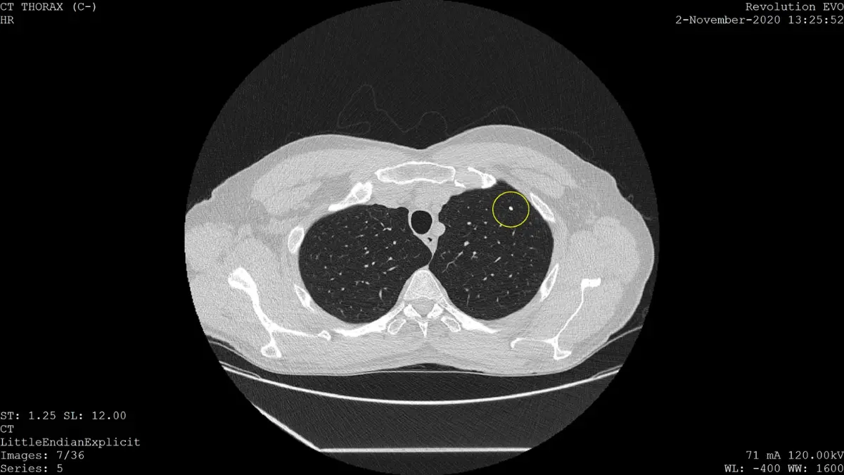 Low-dose lung cancer CT scan at 1.25mm slice showing a calcified pulmonary nodule detected during annual LDCT screening