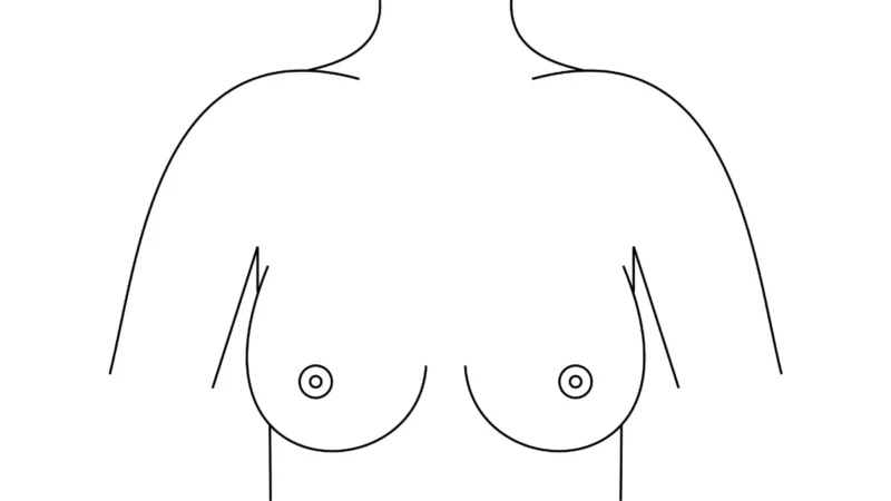Lumpectomy vs Mastectomy illustrated with a simple front-view medical diagram of female breast anatomy.