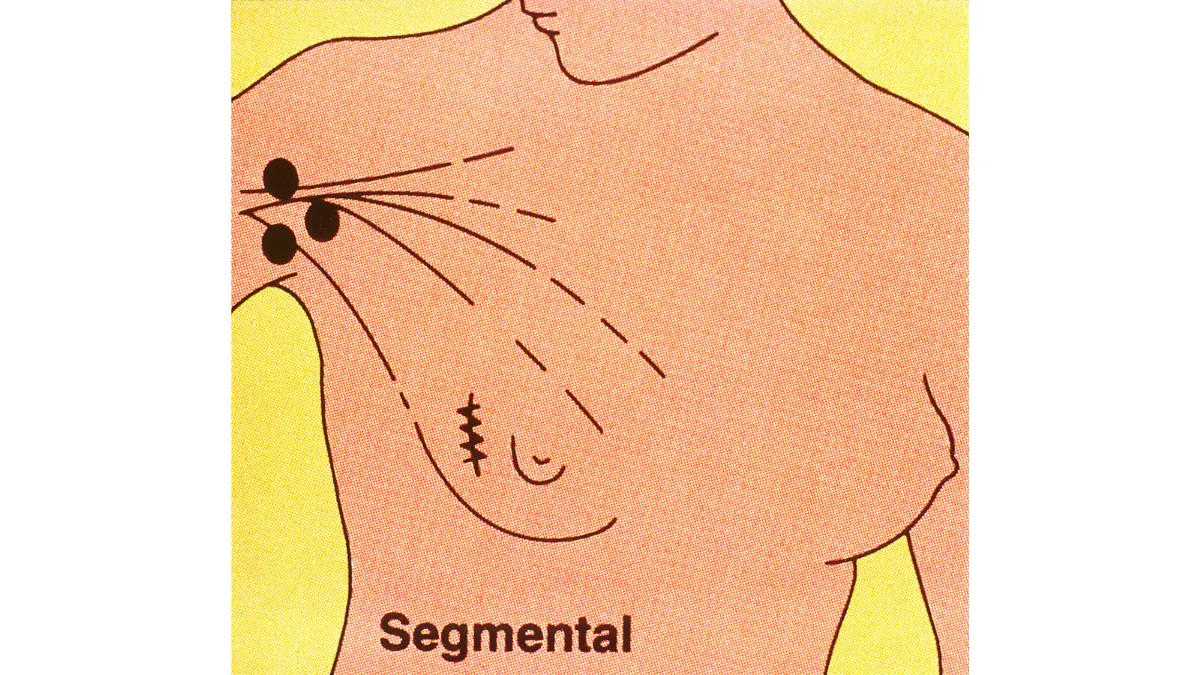 Lumpectomy vs Mastectomy visualized with a medical illustration of a lumpectomy showing removal of a breast tumor and surrounding margin of tissue.
