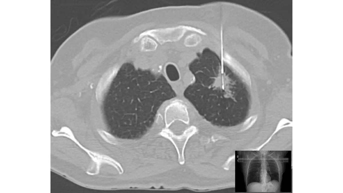 lung biopsy CT-guided needle positioned inside lung nodule during procedure