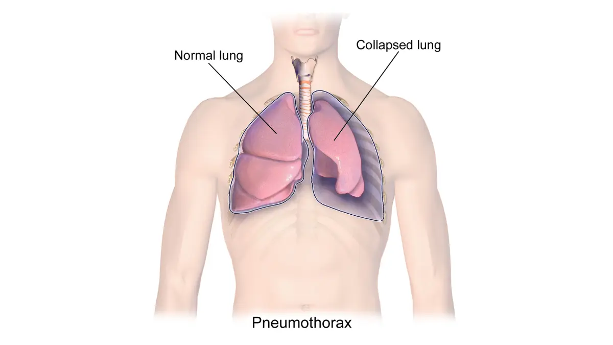lung biopsy risk pneumothorax collapsed lung pleural space air accumulation
