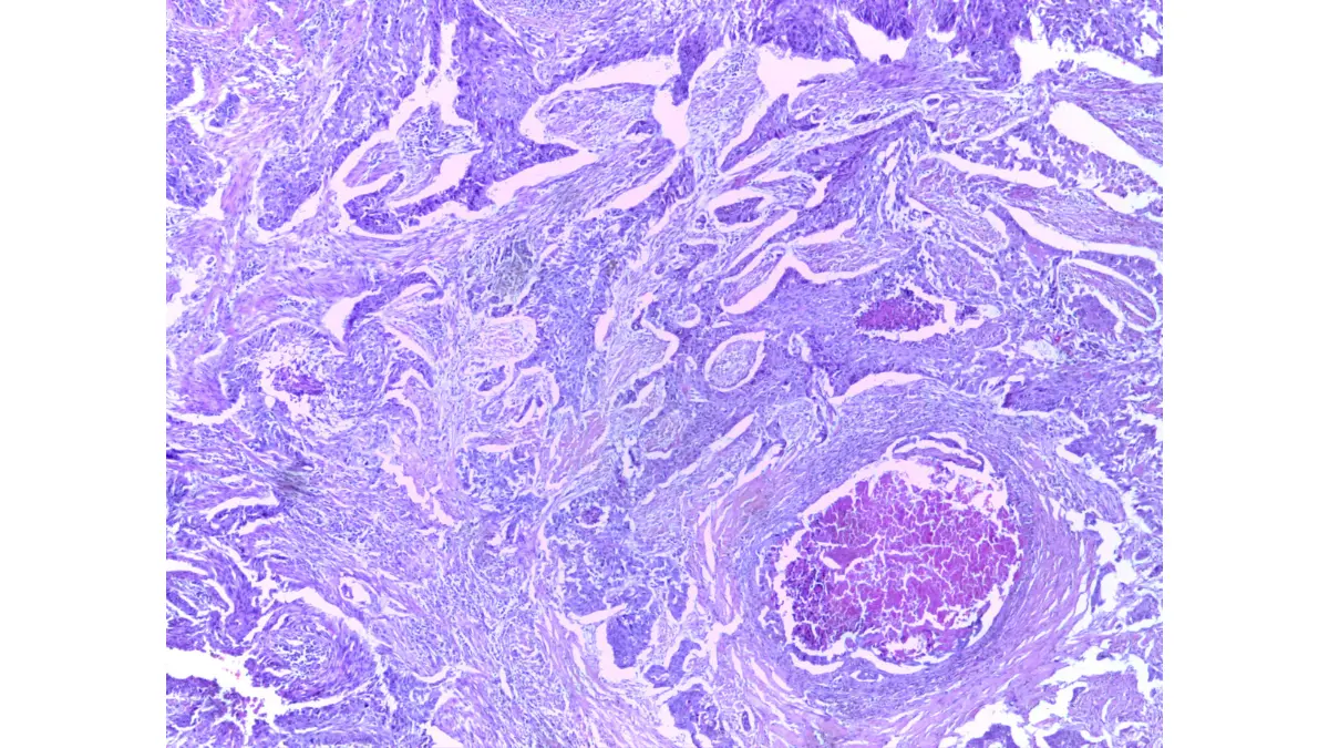 lung biopsy sample histopathology slide showing cancer cells under microscope