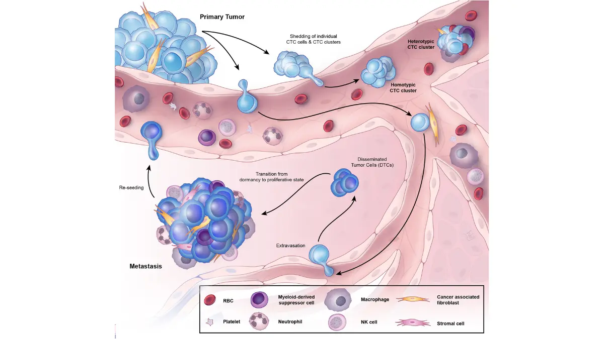 lung cancer has spread – circulating tumor cells traveling through the bloodstream in the metastatic cascade showing how lung cancer spreads to distant organs