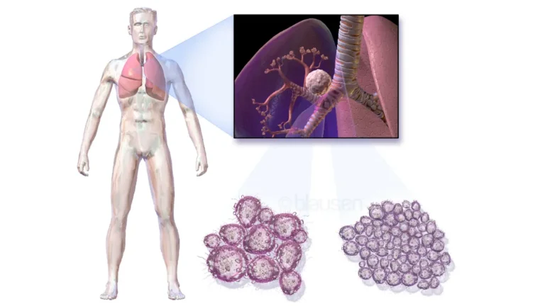 lung cancer complications diagram showing tumor inside human lung anatomy