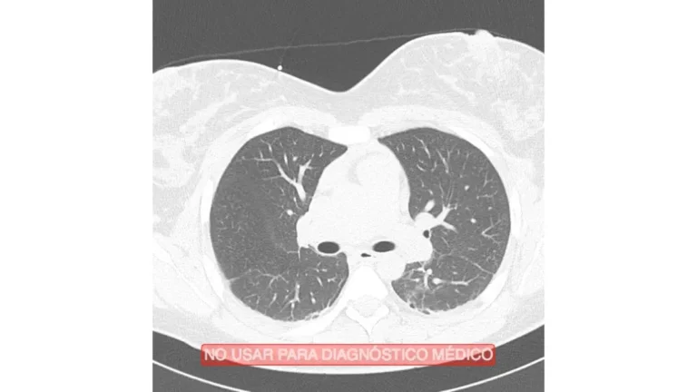 Lung cancer CT scan showing a normal axial cross-section of healthy human lungs used in low-dose LDCT screening programmes