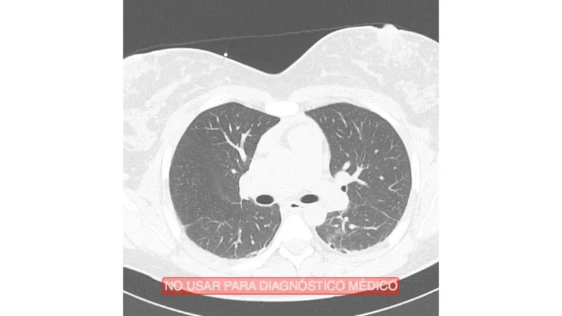 Lung cancer CT scan showing a normal axial cross-section of healthy human lungs used in low-dose LDCT screening programmes