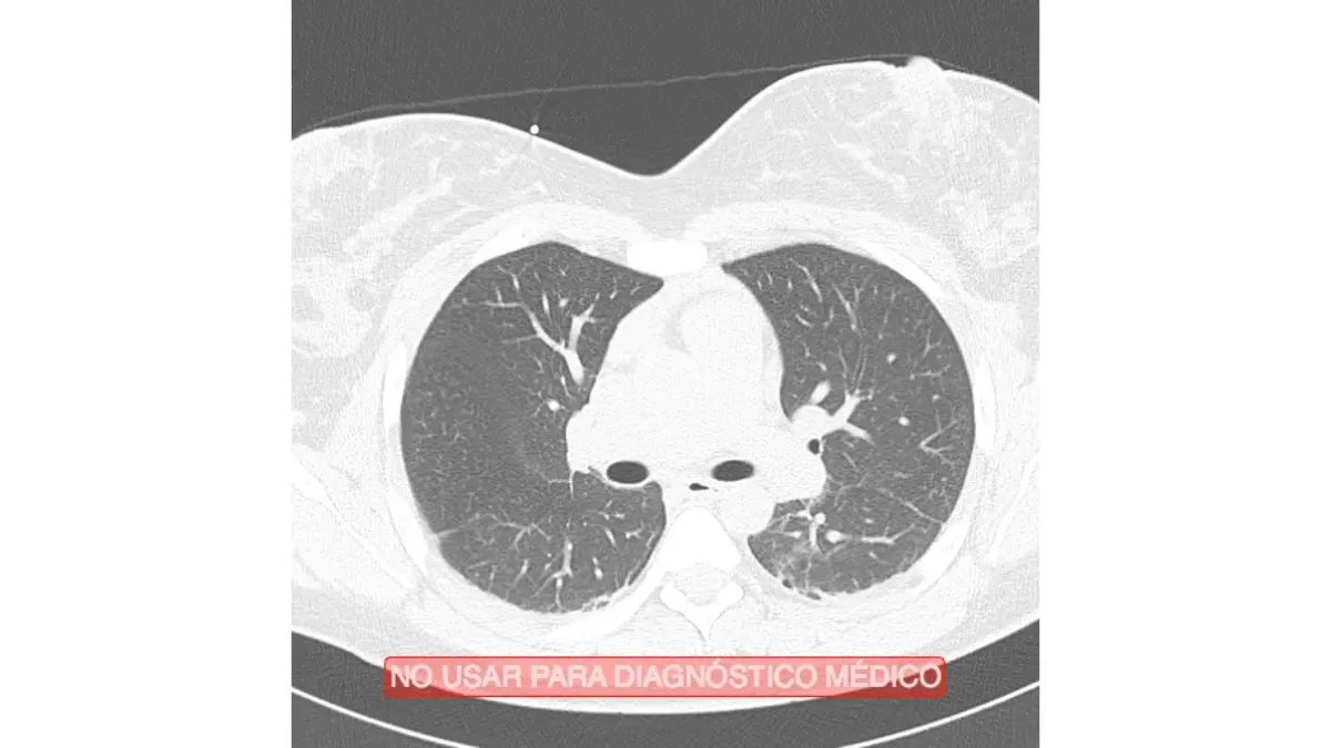 Lung cancer CT scan showing a normal axial cross-section of healthy human lungs used in low-dose LDCT screening programmes