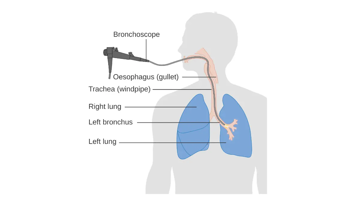 lung cancer diagnosed bronchoscopy procedure diagram showing flexible bronchoscope passed through airway to collect lung biopsy tissue sample