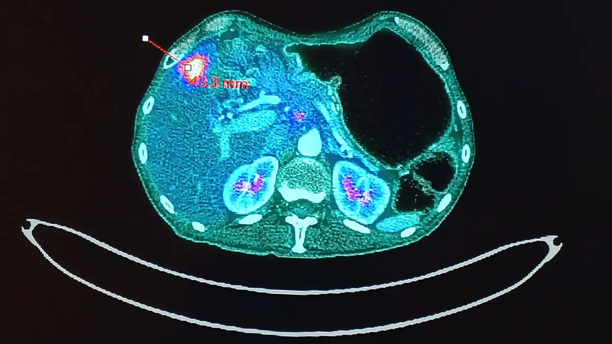lung cancer has spread – PET-CT scan showing metabolically active lung cancer metastasis deposits in abdominal region confirming distant spread