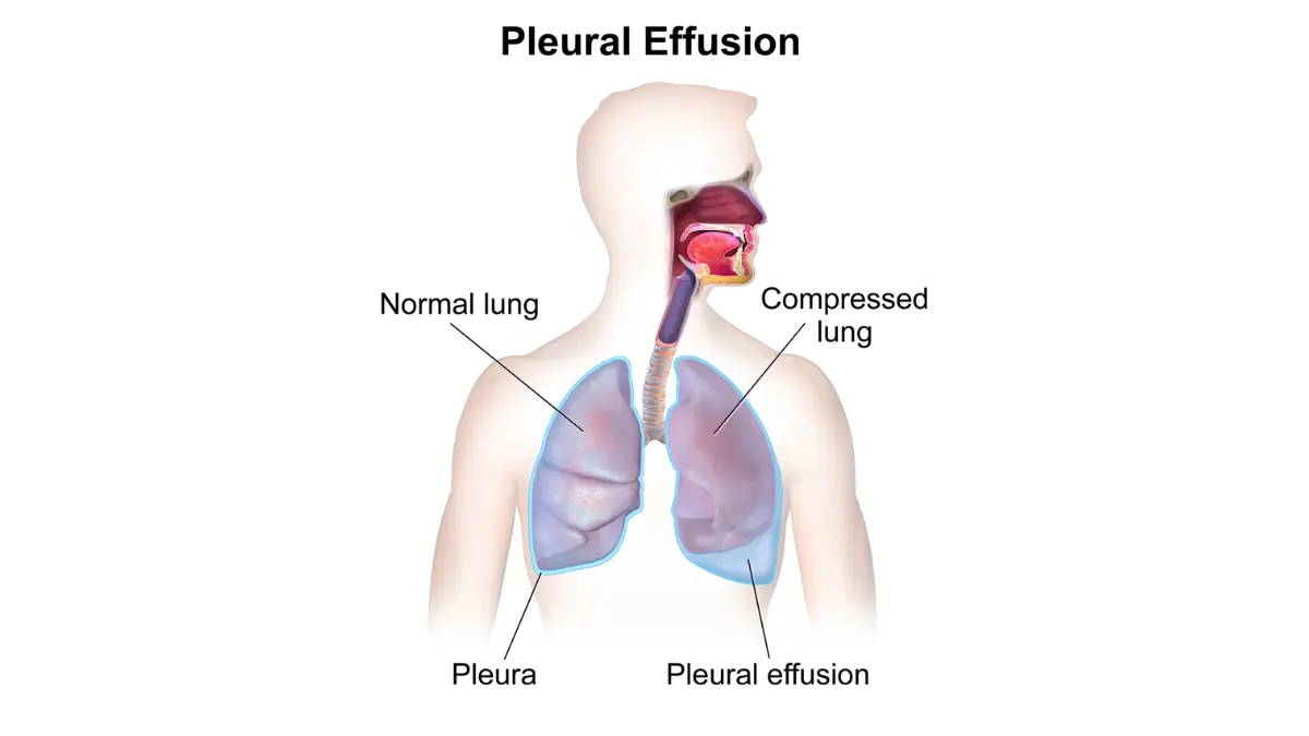 lung cancer complications pleural effusion fluid buildup around lung anatomy diagram