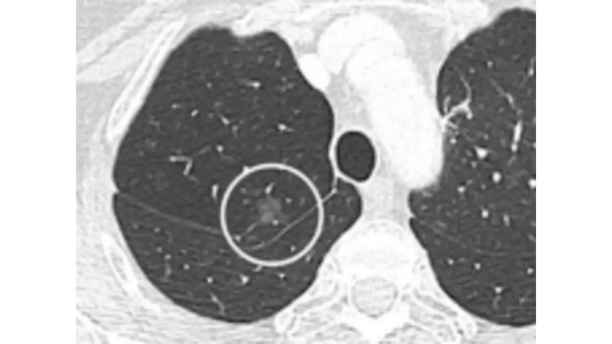 Lung Cancer Screening — CT scan image showing a ground-glass lung nodule representing a Lung-RADS 3 probably benign finding requiring 6-month follow-up imaging not immediate biopsy