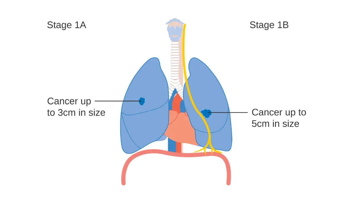 Medical diagram showing Stage 1A lung cancer up to 3cm and Stage 1B lung cancer up to 5cm — lung cancer prognosis and TNM staging classification