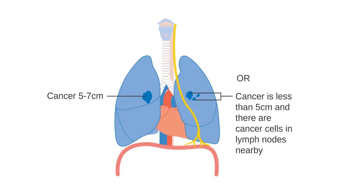 Medical diagram showing Stage 2A lung cancer with 5–7cm tumor or cancer cells in nearby lymph nodes — NSCLC lung cancer prognosis and survival rates
