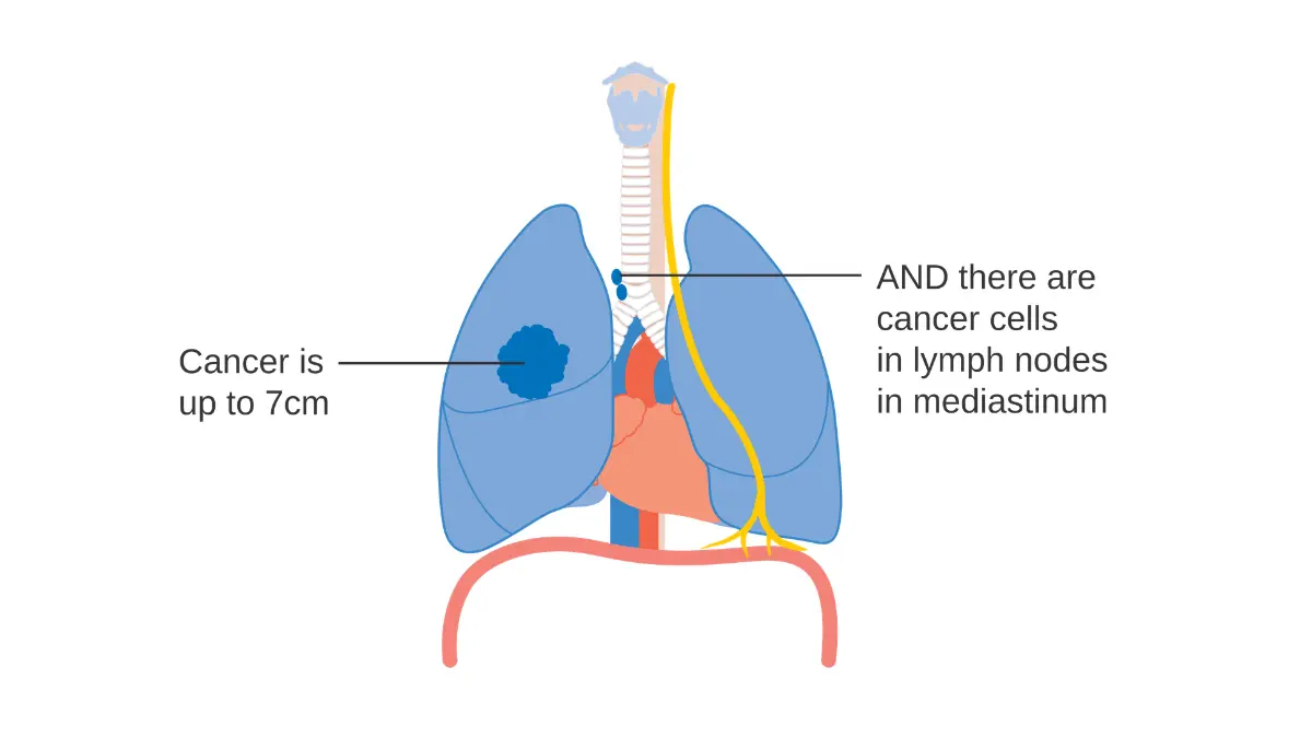 Medical diagram showing Stage 3A lung cancer with tumor up to 7cm and cancer cells in mediastinal lymph nodes — lung cancer prognosis COPD surgical eligibility and ECOG performance status