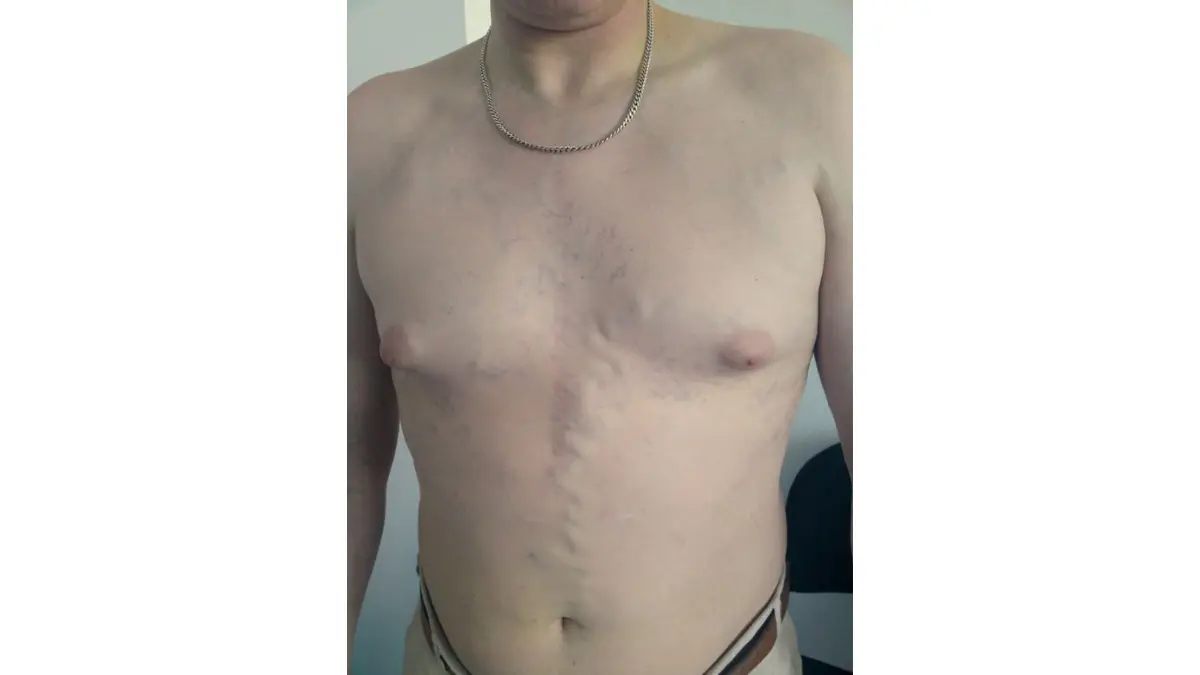 lung cancer complications superior vena cava syndrome facial swelling neck veins anatomy