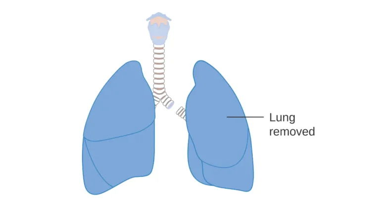 lung cancer surgery pneumonectomy diagram showing complete removal of whole lung CRUK