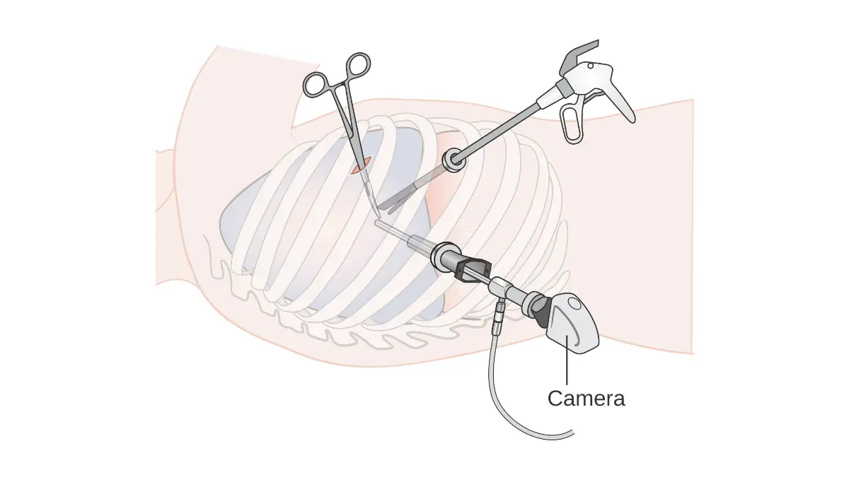 lung cancer surgery VATS video assisted thoracoscopy diagram minimally invasive procedure small incisions
