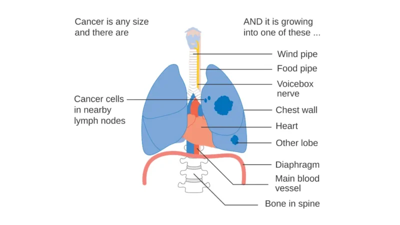 lung cancer treatment stage 3A NSCLC locally advanced tumor lymph node spread diagram 2026