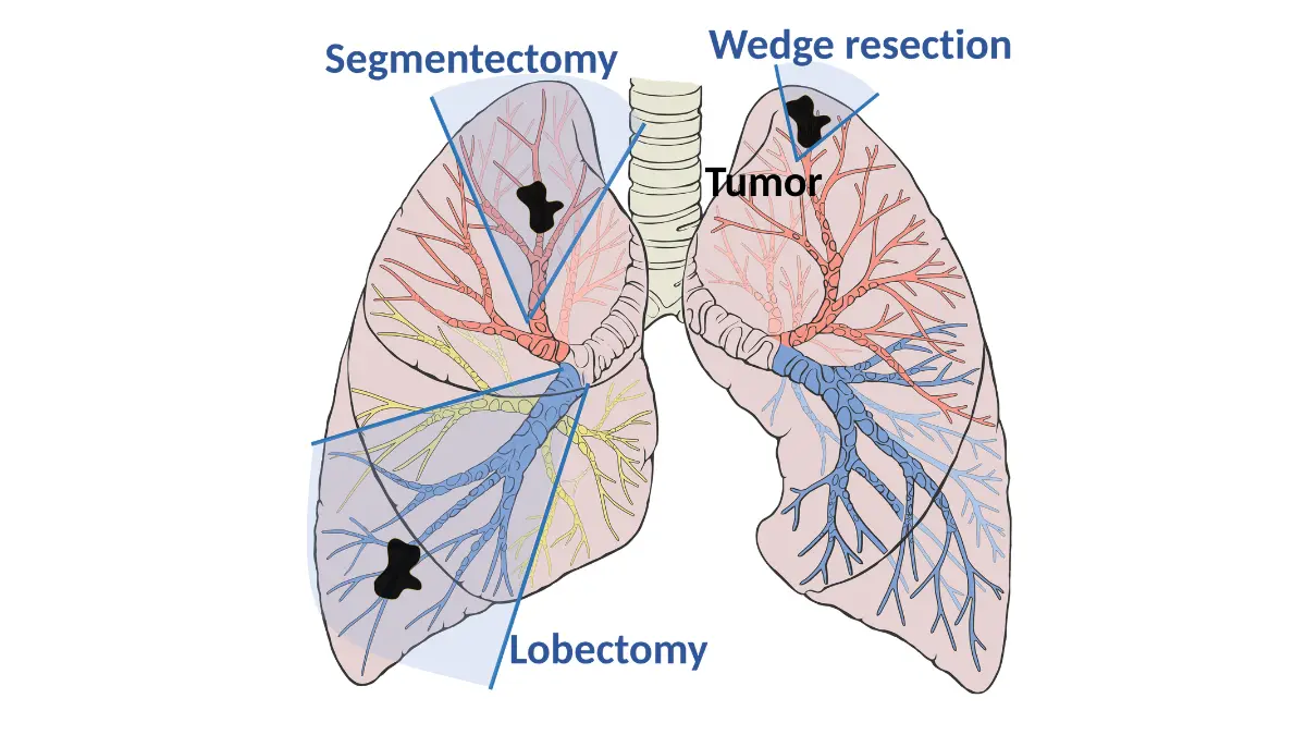 lung cancer complications treatment surgery diagram showing tumor resection anatomy