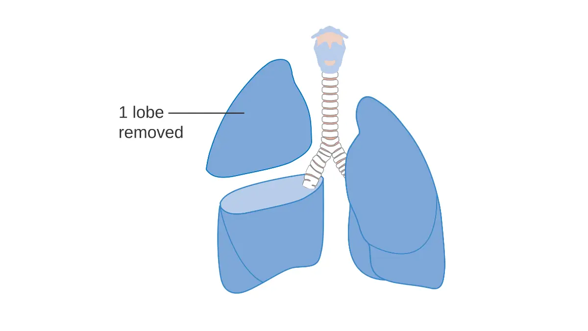 lung cancer treatment surgery lobectomy removal of one lobe NSCLC early stage curative operation 2026