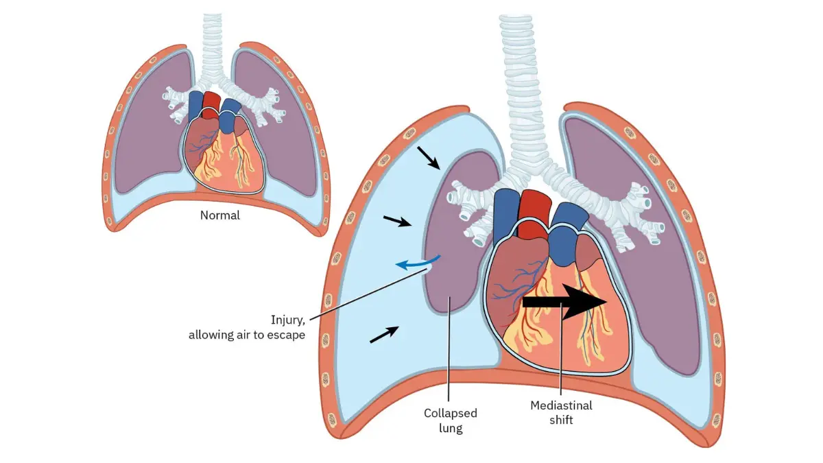 lung cancer palliative care lung collapse and pleural pressure anatomy illustration for dyspnea management