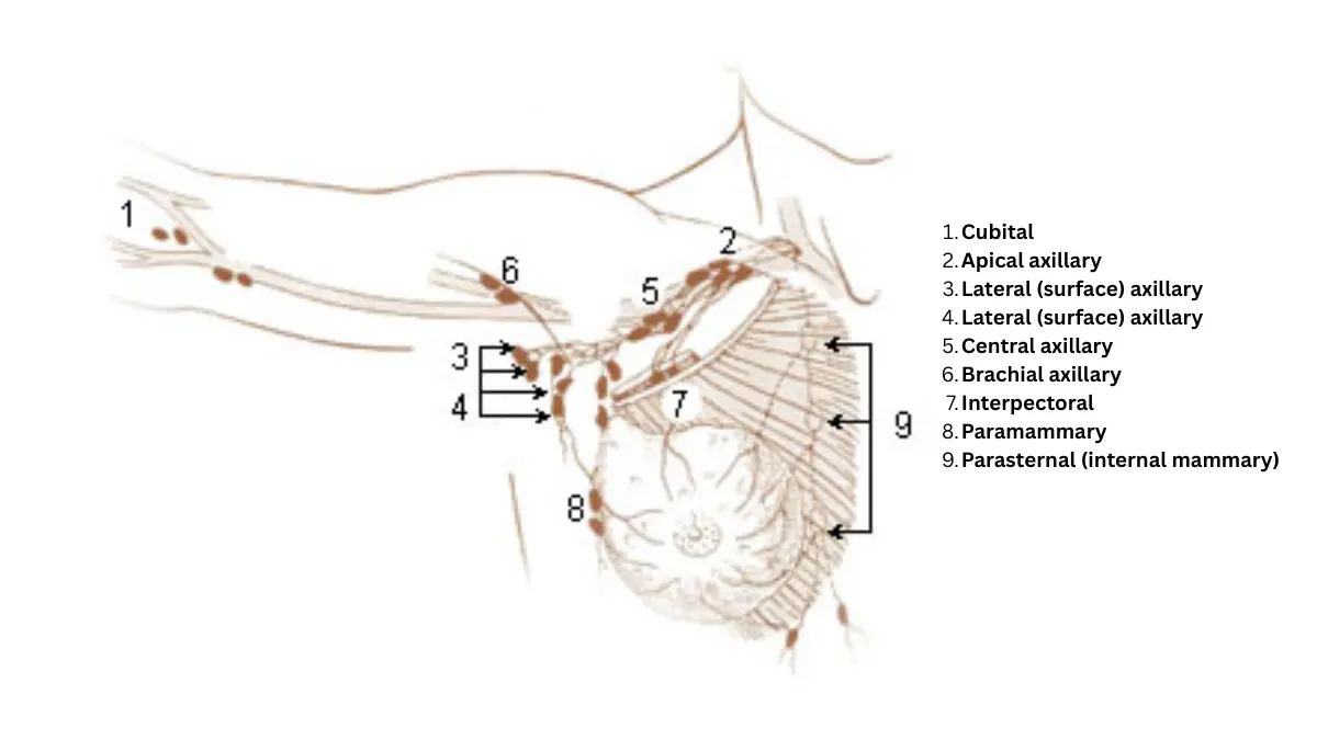 Lymphedema axillary lymph nodes and vessels in the upper torso, shoulder, and arm region.