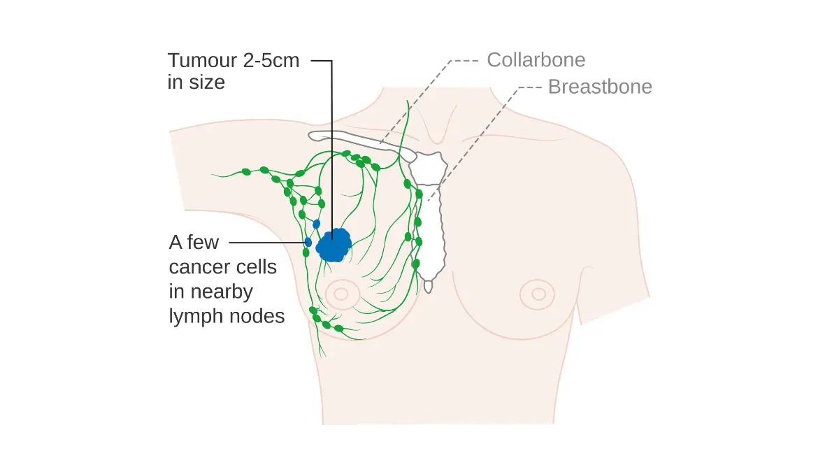Male breast cancer stage illustration showing breast tumor extent and regional spread concept for survival-by-stage context.