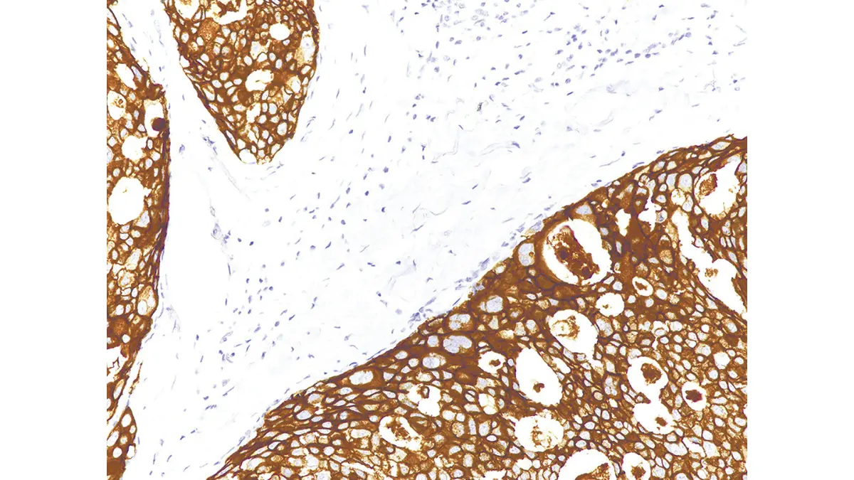 Metastatic Breast Cancer monoclonal antibody targeted therapy illustration for HER2-directed treatment