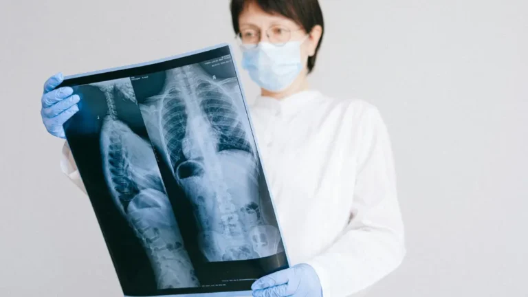 Physician reviewing a chest X-ray result to prevent lung cancer through clinical screening and early detection assessment